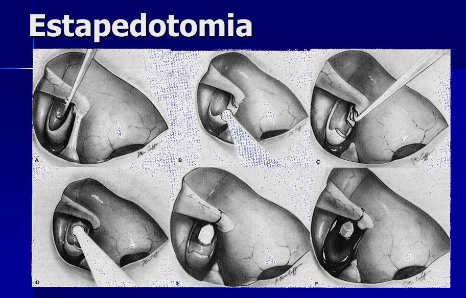 Estapedotomia