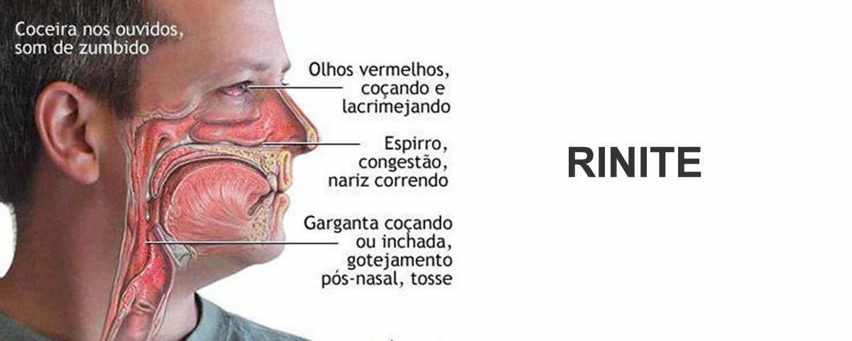 Sinusite e Rinite
